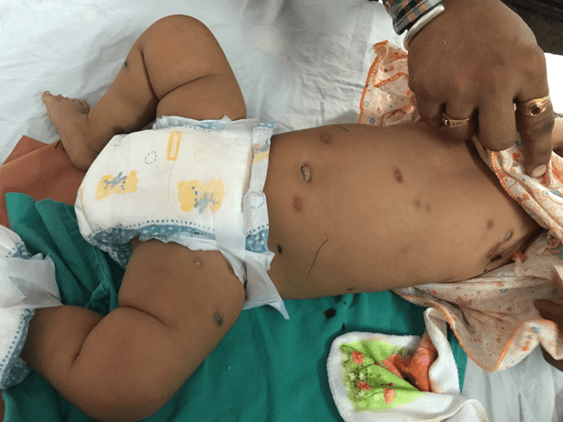<b>Figure 1.</b> Cutaneous TB in a child with disseminated TB.