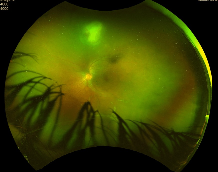 <b>Figure 1.</b> Ultra-widefield pseudo-colour retinography of the left eye showing a white focal retinitis with overlying vitreous inflammation (headlight-in-fog sign), along with papillitis and widespread vasculitis. The right eye showed no abnormalities.